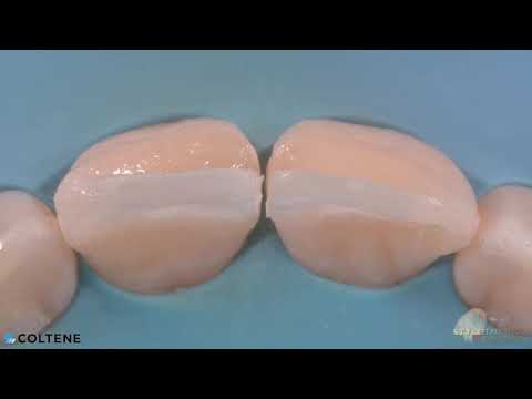 CCC - Monaldo Saracinelli StyleItaliano (Direct anterior multilayer restoration2) BRILLIANT EverGlow