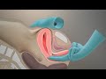 The Pelvic Examination TVASurg