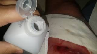 WARNING *** GRAPHIC CONTENT - Removing Packing from Wound