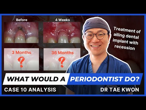 What Would A Periodontist Do? With Dr Tae Kwon - Case 10