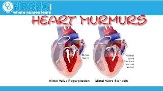Heart Murmurs | Aortic/Mitral Stenosis, Regurgitation | How to identify