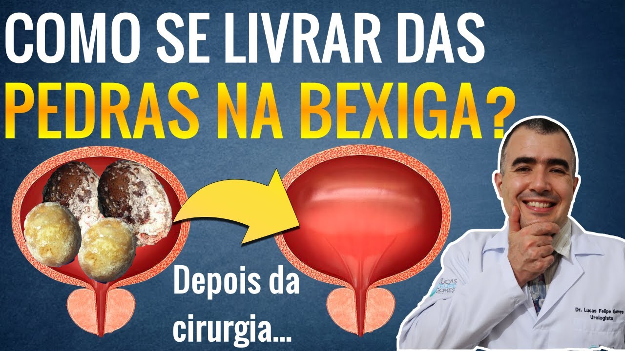 Watch Now Qual a melhor cirurgia para tirar uma PEDRA NA BEXIGA Qual a melhor cirurgia para tirar uma PEDRA NA BEXIGA