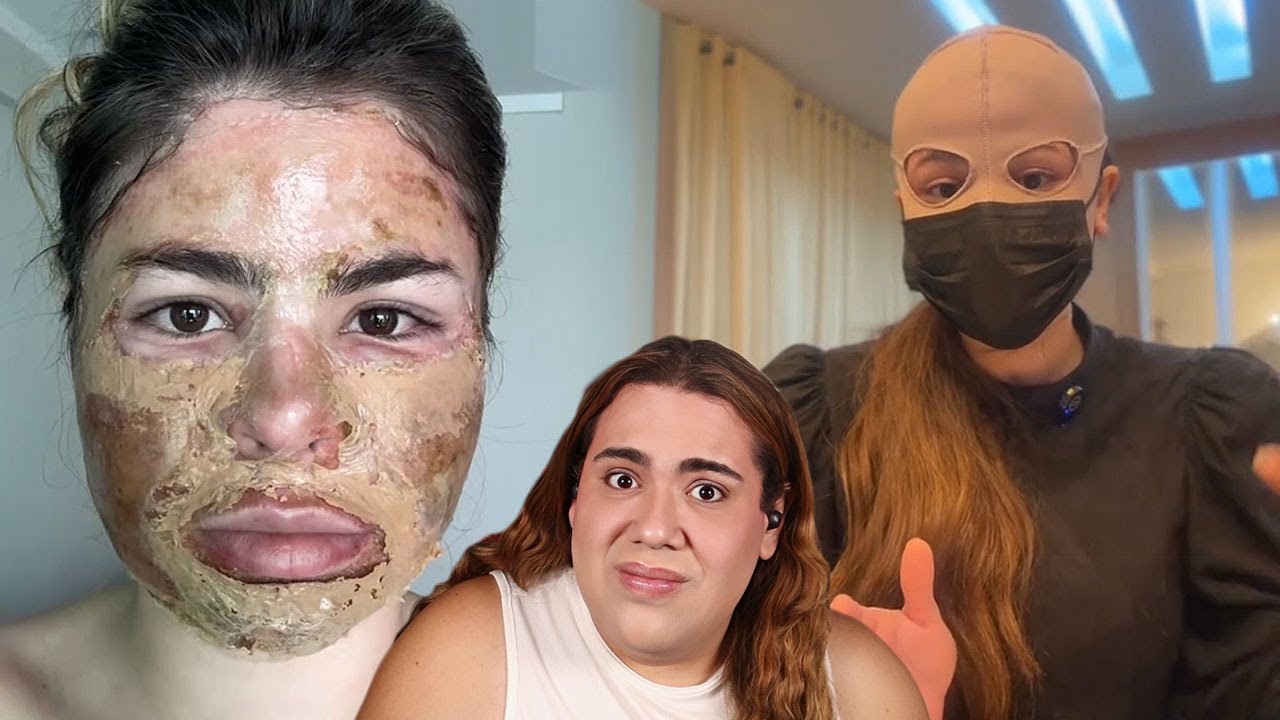 FIZ UM PROCEDIMENTO QUE DESTRUIU A MINHA PELE