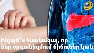 Ինչպե՞ս հասկանալ, որ ձեր օրգանիզմում ճիճուներ կան