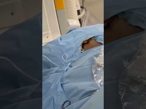 Femoral Endarterectomy| Restoring Blood Flow to the Legs | Dr. Abhilash V