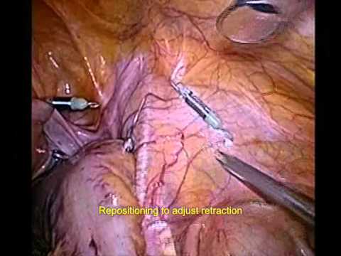EndoGrab para la retracción del sigmoideo y mesocolon durante la sigmoidectomía