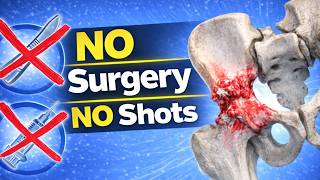 The Only Cure For Hip Arthritis That Actually Works (not surgery or injections)