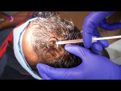 PRP Therapy After Hair Transplantation In India 2019