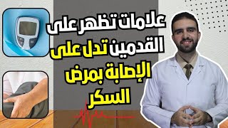 علامات القدمين التي لا يجب تجاهلها:  تدل على مرض السكري