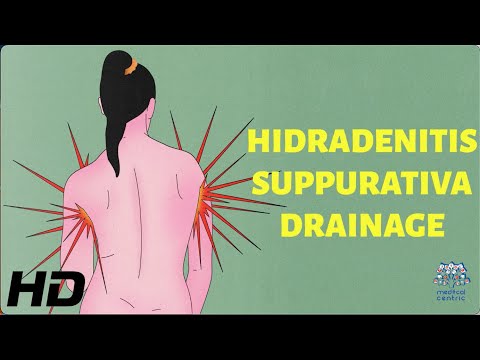 All About Allergy Shots