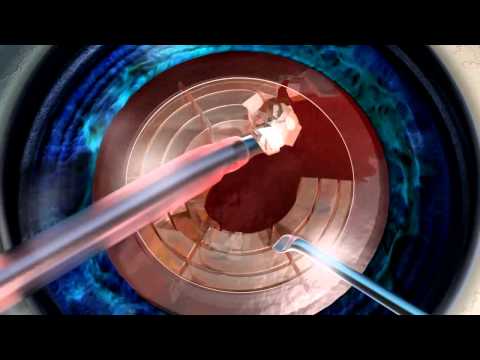 Laser-Assisted Cataract Surgery @ Eye Medical Center of Fresno