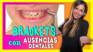 🧐¿Se pueden 𝗣𝗢𝗡𝗘𝗥 𝗕𝗥𝗔𝗖𝗞𝗘𝗧𝗦 si faltan MUELAS O DIENTES Ortodoncia con AUSENCIA de DIENTES 😱