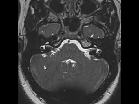 Gefäßschleife im IAC