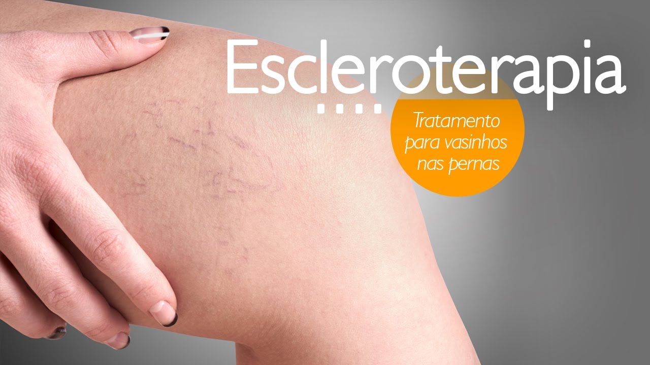Escleroterapia (vasinhos nas pernas)