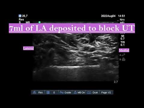 Selective Trunk Block(SeTB)