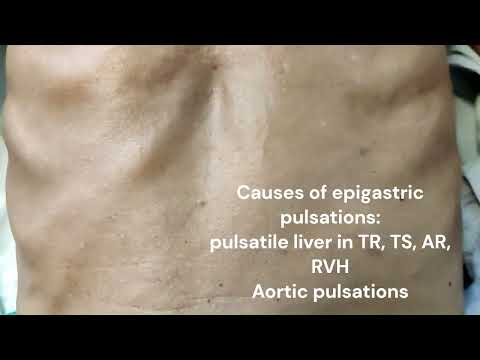 Epigastric pulsation; Department of Medicine; DMIHER