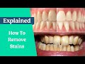 How to remove stains from the teeth