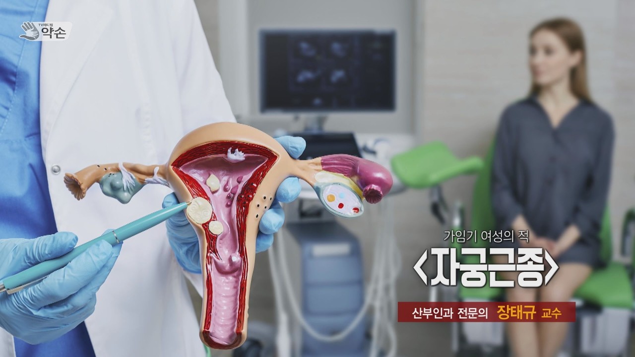 가임기 여성의 적, '자궁근종' ㅣ 산부인과 장태규 교수 관련사진