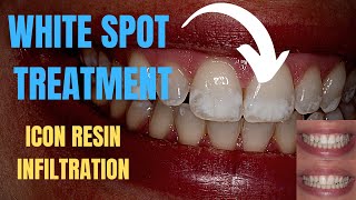 White Spots Fluorosis Smile Transformation - Before and After Procedure with ICON Resin Infiltration