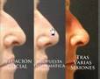 Rinomodelación - Nariz aguileña (III) (sin rinoplastia ...