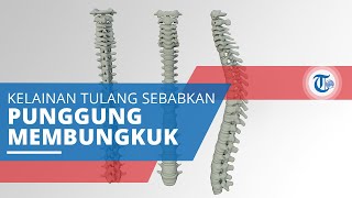 Kifosis, Kelainan Tulang Belakang yang Menyebabkan Penderitanya Mengalami Pembungkukan Punggung