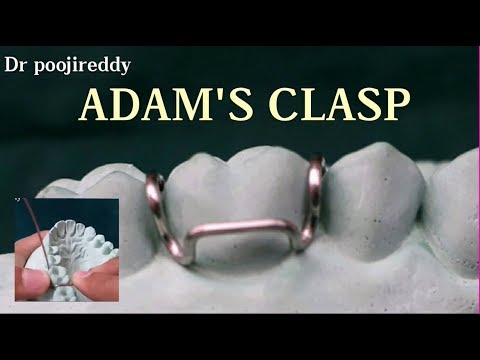 Adams clasp |Adams clasp fabrication |Dr poojireddy