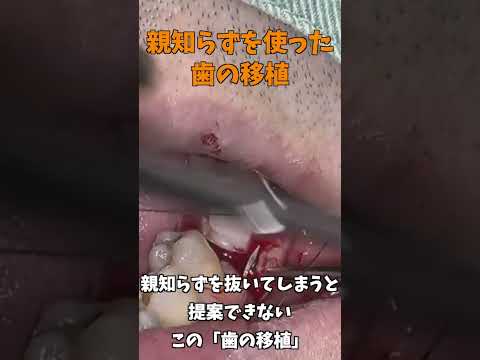 生命歯学科 【閲覧注意】歯を残す第4の選択肢「歯牙移植」　親知らずを利用した歯の移植について　#shorts