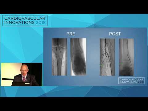 CVI2018 Session: Crossing tibial lesions, wire based approach, step by step techniques