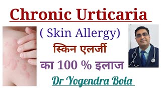 Chronic Urticaria (Skin Allergy) के कारण and Complete Treatment in Hindi