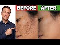 How to Get Rid of Hyperpigmentation (Aging or Dark Spots)