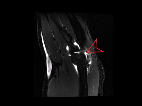 Elbow MRI: Idiopathic Joint Effusion