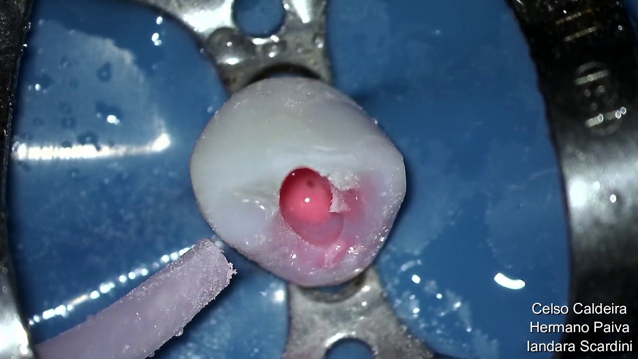 Cirurgia de acesso para tratamento Endodôntico de Canino Inferior