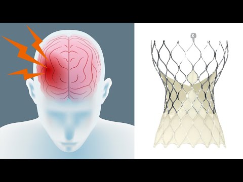 Stroke Risk & Transcatheter Aortic Valve Replacement (TAVR) with Dr. Isaac George