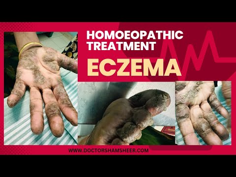 ECZEMA