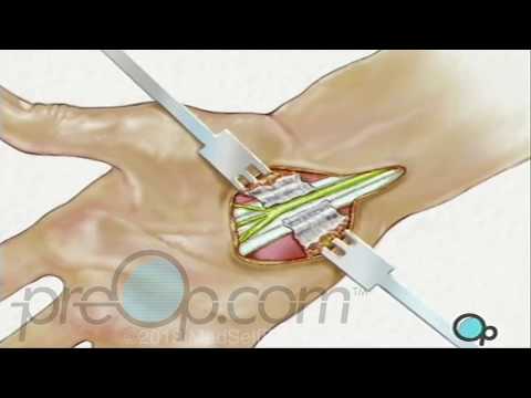 Carpal Tunnel Syndrome Surgery - PreOp Patient Education