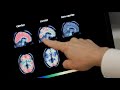 Alzheimer's in Indiana: New numbers predict the disease's future for Hoosiers