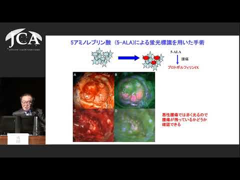 栄養学科 講演3「脳腫瘍の診断と治療」成田 善孝（国立がん研究センター中央病院 脳脊髄腫瘍科 科長）