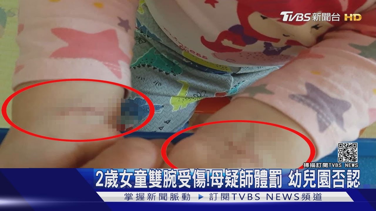 2歲女童雙腕受傷！母疑師體罰　幼兒園否認