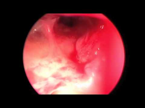 Balloon Dilation of Ostium under Local Anesthesia