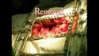 Lenadora Retractor 01.flv