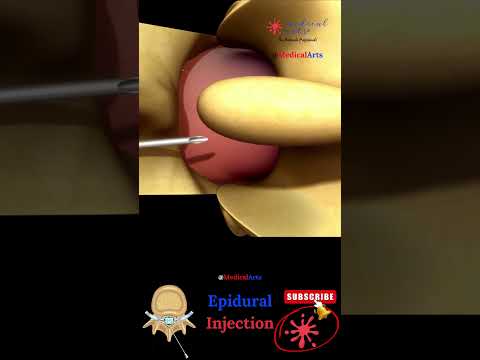 Epidural Injection - Epidural Anesthesia