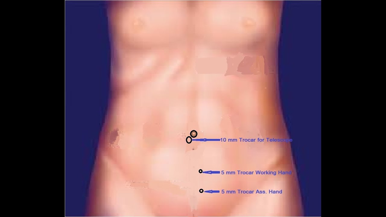 TEP Right Hernia