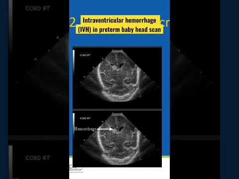 Intraventricular hemorrhage (IVH) in preterm baby head scan #nicu  #IVH #preterm