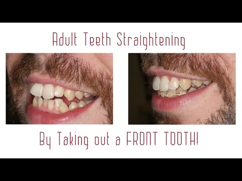 download lagu mp3 mp4 Two Front Teeth Crooked, download lagu Two Front Teeth Crooked gratis, unduh video klip Two Front Teeth Crooked