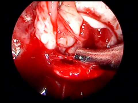 Macroadenoma Of Hypophysis