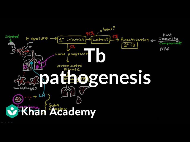 Video Pronunciation of miliary tuberculosis in English Video Pronunciation of miliary tuberculosis in English