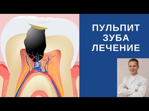 Пульпит. Лечение зуба.