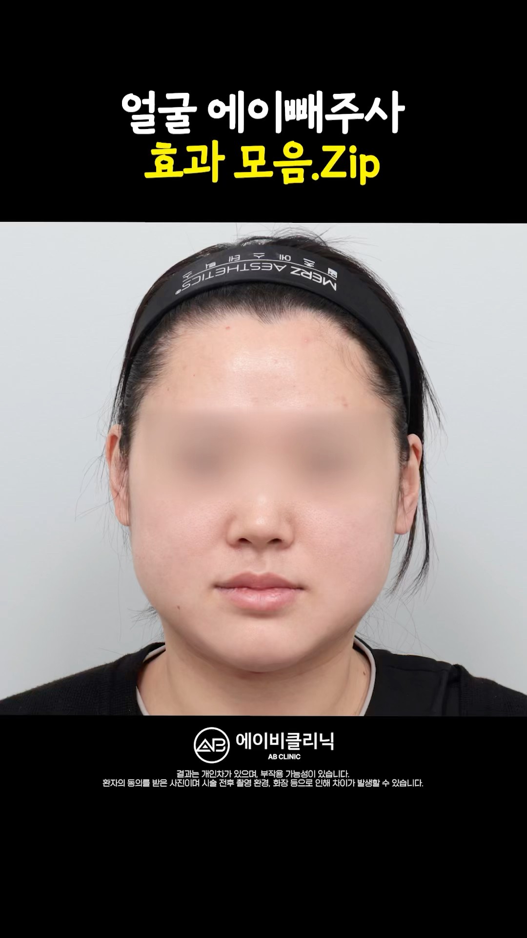 이중턱이랑 작별한 에이빼 전후 모음.ZIP