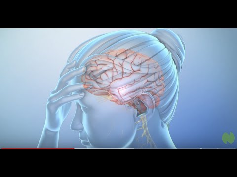 What Is a Migraine Headache?