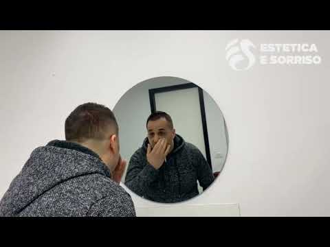 Rinoplastica in Albania - Andrea Palmieri